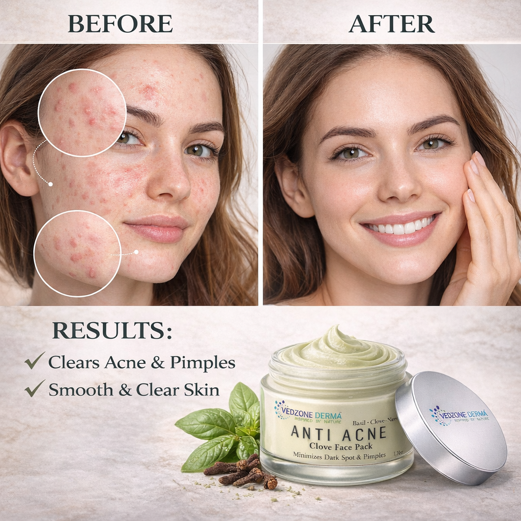 Ayurvedic Anti Acne Clove Face Pack for Minimizing Dark Sports and Pimple; 50g.